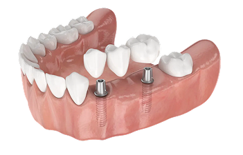 Основные показания к установке: