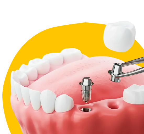 Удаление зубного импланта