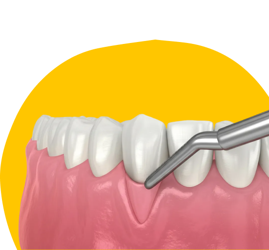 Пластика десны 