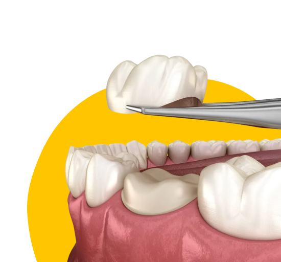 Установка зубных коронок