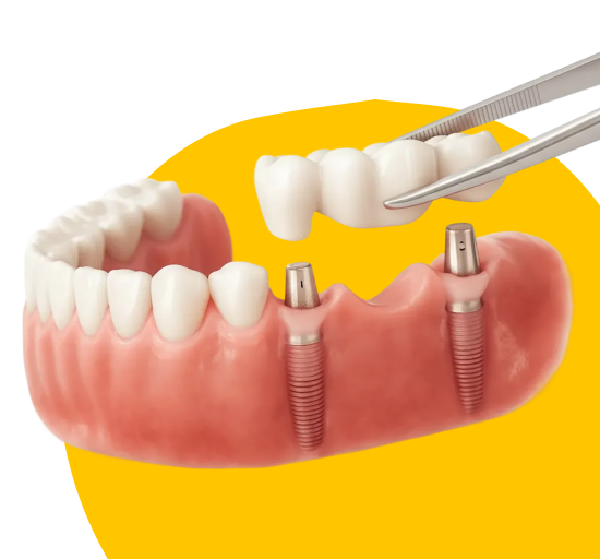 Установка Зубного Моста 