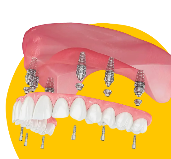 Несъемное протезирование зубов