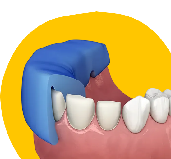 Wax-Up моделирование