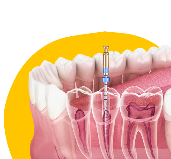 Лечение пульпита
