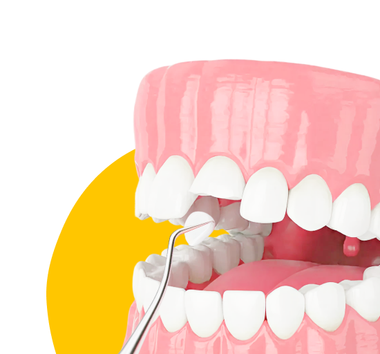 Наращивание зубов