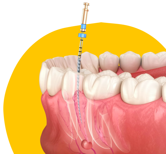 Лечение периодонтита