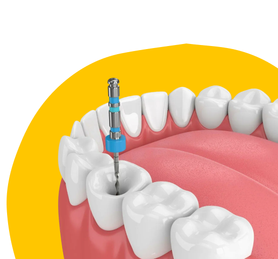Лечение каналов молочных зубов в Кишинёве
