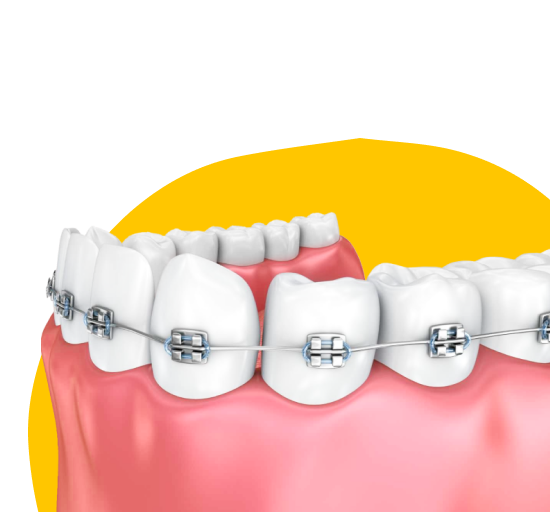 Установка брекетов