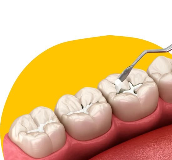 Герметизация Фиссур 