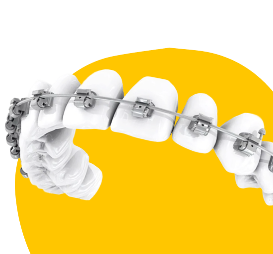 Самолигирующие брекеты 