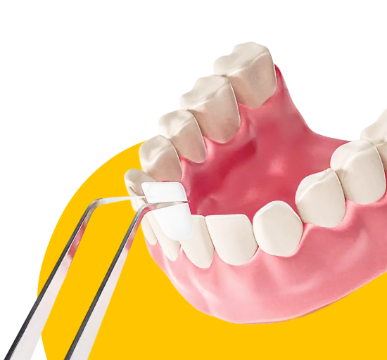 Установка Виниров