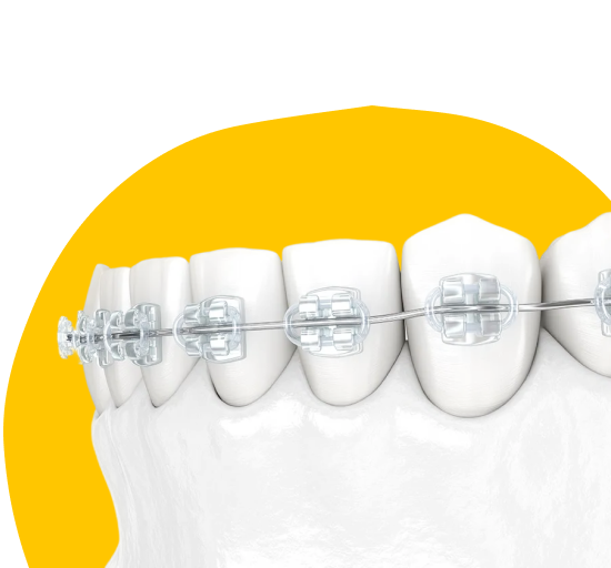 Керамические брекеты