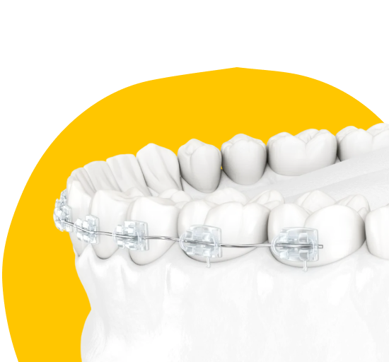 Сапфировые брекеты