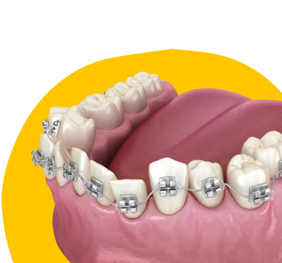 Металлические брекеты