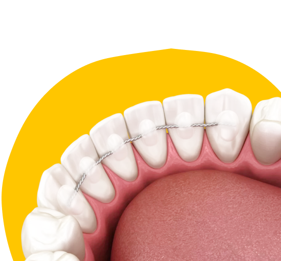 Подбор и установка Ретейнеров