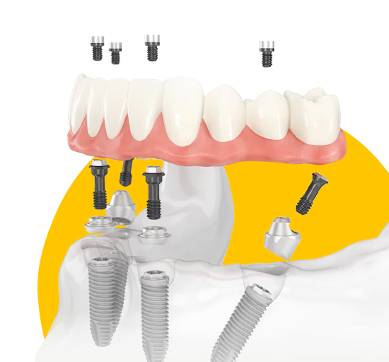 Имплантация All-on-4