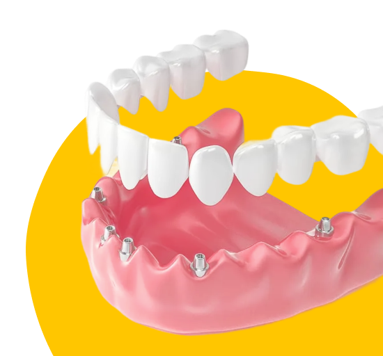 Имплантация по протоколу All-on-6  
