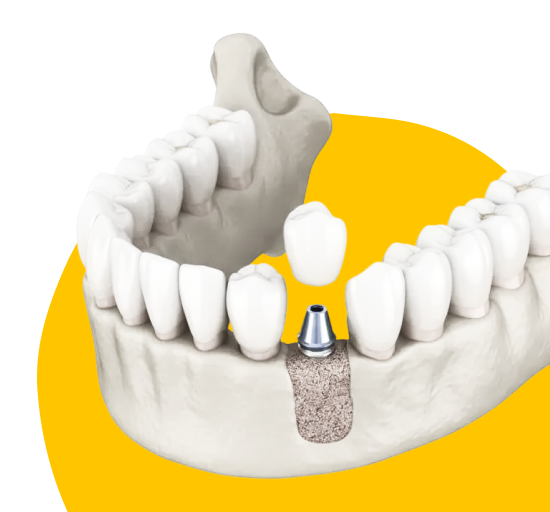 Синус-лифтинг