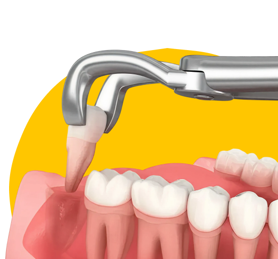 Удаление ретинированного зуба