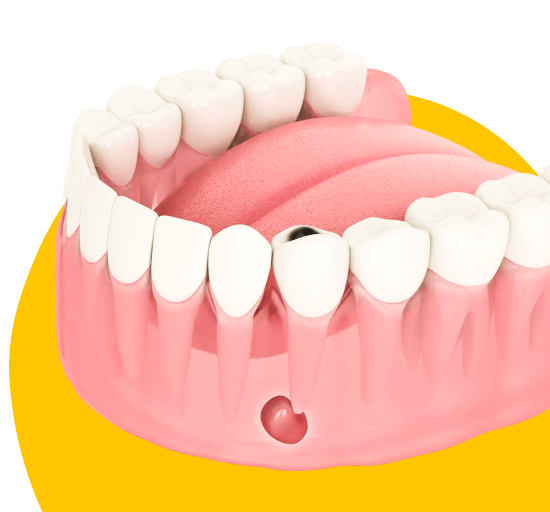 Удаление кисты зуба 