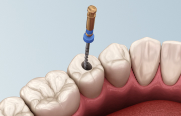Лечение пульпита в 5 этапов: