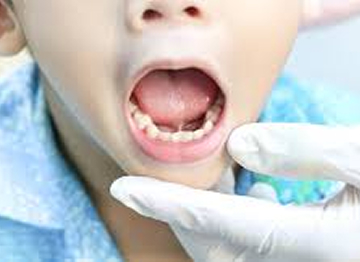 Почему важно вовремя сделать френулопластику?