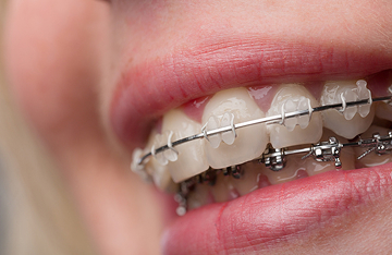 Путь к вашей улыбке: всего 5 шагов!