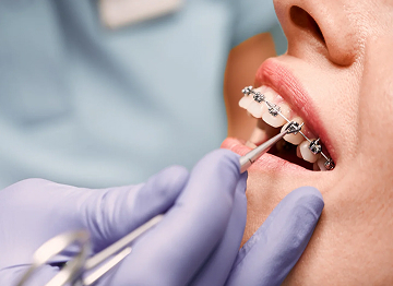 Когда ставят лигатурные брекеты ?