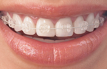 5 шагов к красивой улыбке