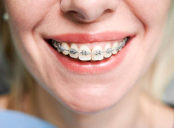 Алгоритм устаовки брекетов