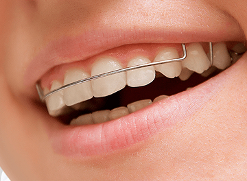 Как проходит установка ретейнеров: