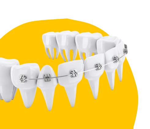 Подбор брекетов - целая наука