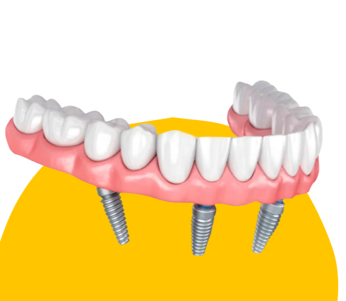 Почему выбирают All-on-4 в Atmosfera: